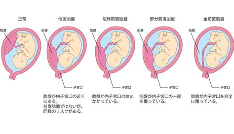 胎盤低注意事項